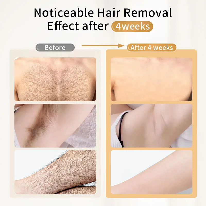 FOR T001 48W Laser Hair Remova - Ipl Hair Removal Handset Permanent 评论和价格