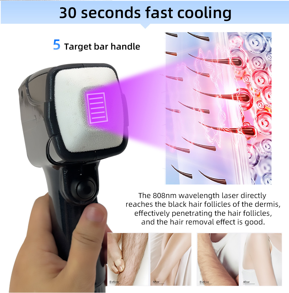 New Style Portable 808 NM Wave - Alexandrite Laser Hair Removal Machine 评论和价格
